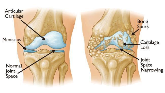 CHAPTER I The human knee joint 1.4 Total Knee Arthroplasty 1.4.1 Introduction The knee joint has to bear very high forces in all the human daily activities and works for countless cycles during the life.