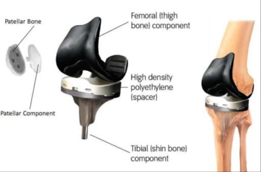 CHAPTER I The human knee joint 1.4.2 TKA components The surgical procedure in which a knee prosthesis is implanted is known as Total Knee Arthroplasty (TKA).