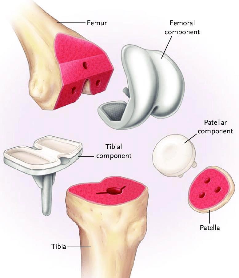 CHAPTER I The human knee joint Fig. 1-13. Components of Total Knee Arthroplasty.