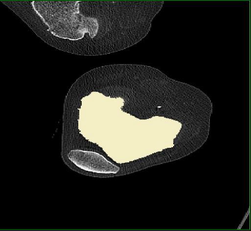 5 mm/rev (Figure 3-3). Raw data were processed using a bone filter and the images were stored in DICOM format.