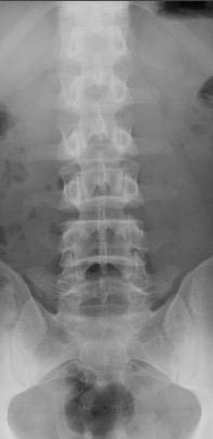 Spondylitis: Bamboo Spine, Lumbar Vertebrae