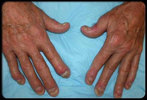 Distal Interphalangeal Predominant (DIP) Tips Patterns Pathogene sis Morbidity Distal interphalangeal predominant psoriatic arthritis involves primarily the small joints in the fingers
