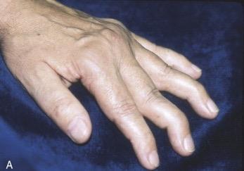 PIP and DIP synovitis Subclinical Clinical