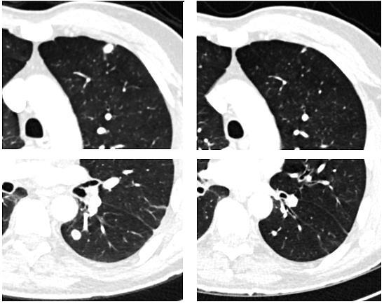 CALM Phase 2 trial Non-injected distant lung lesion
