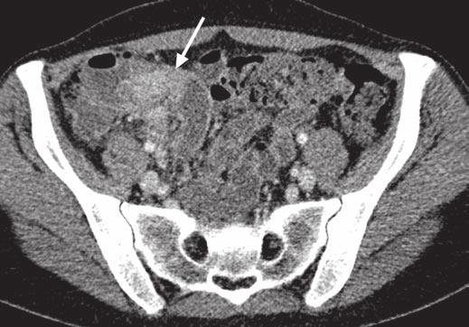 girth has been used as a guide to adjust kvp in pediatric CT (Gamberoni J et al., presented at the 2009 annual meeting of the American Roentgen Ray Society). Kalra et al.