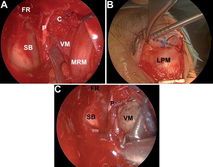 Management of a Selected Superomedial IOL Castelnuovo et al. e107 Fig. 2 Intraoperative sequential view of the main surgical steps of the push pull technique. (A) Transnasal exposition of the lesion.