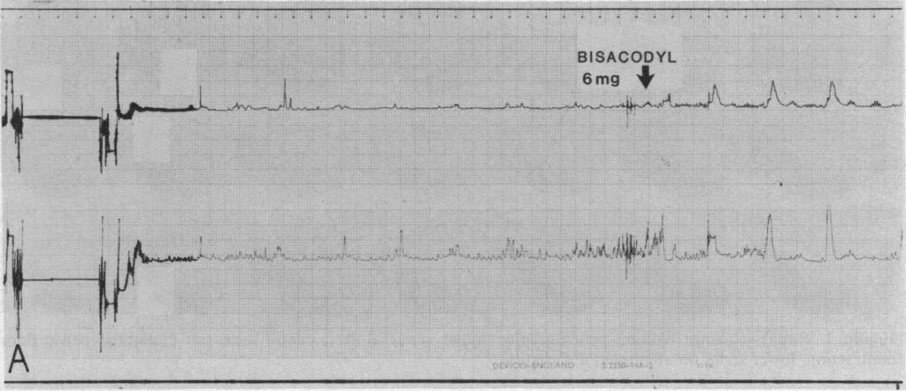 Journal of the Royal Society of Medicine Volume 77 July 1984 561 Figure 2. Sigmoid pressure traces. The upper trace is at 15 cm from the anal verge and the lower at 10 cm from the anus.