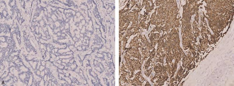 Medicine Volume 93, Number 27, December 2014 Significance of Chromogranin A in GEP-NEN patients FIGURE 1. Immunohistochemical staining of CgA.