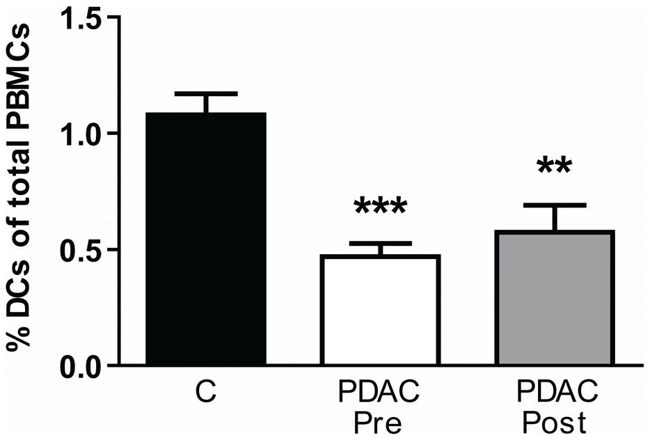 Figure 1. Decreased levels of MDCs and PDCs in patients with PDAC.