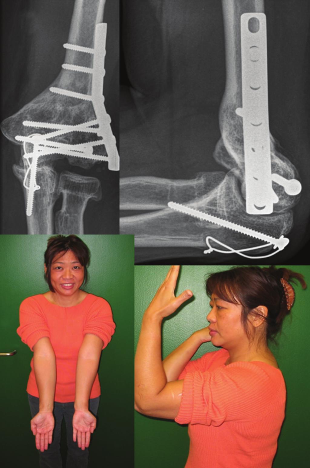 3 (e) (f) Figure 1: (a) Our patient was a 48-year-old dentist who was seen 10 months after a high energy fall that resulted in a complex intraarticular fracture of her left nondominant distal humerus.