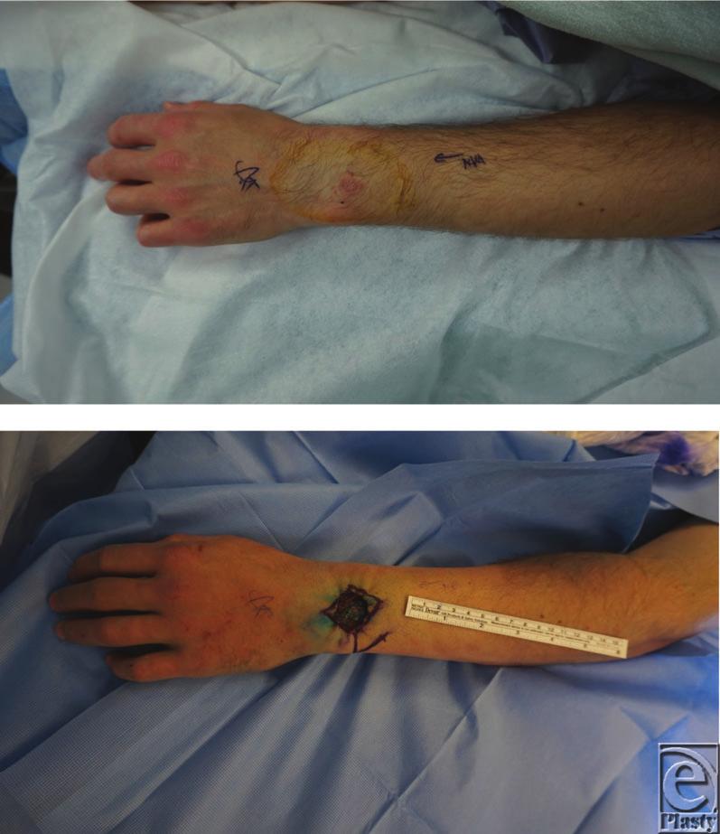 Interesting Case Series Reconstruction of Dorsal Wrist Defects Maelee Yang, BS, and Joseph Meyerson, MD The Ohio State University Wexner