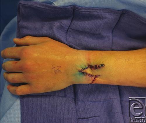 DESCRIPTION A 32-year-old man presented for excision