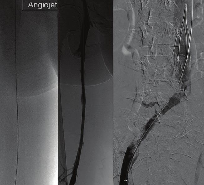 Initial imaging demonstrates use of the AngioJet Solent throbectomy system (Boston Scientific Corporation) alone.