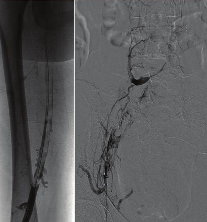 Given the presence of persistent narrowing proximally, an additional 24-mm Wallstent was placed which allowed excellent flow (B). The patient s symptoms and edema resolved within days. sheaths.