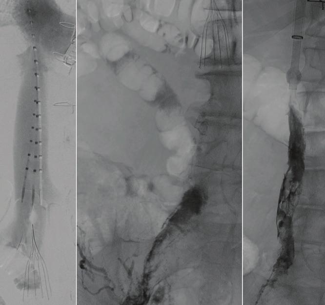 A venogram demonstrates iliocaval thrombosis with a small amount of thrombus noted at the IVC filter hook. Figure 3.