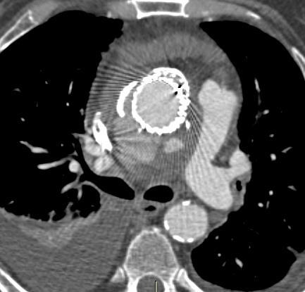 Aortic Pathologies - Ascending: 19 pts Outcome data at 1