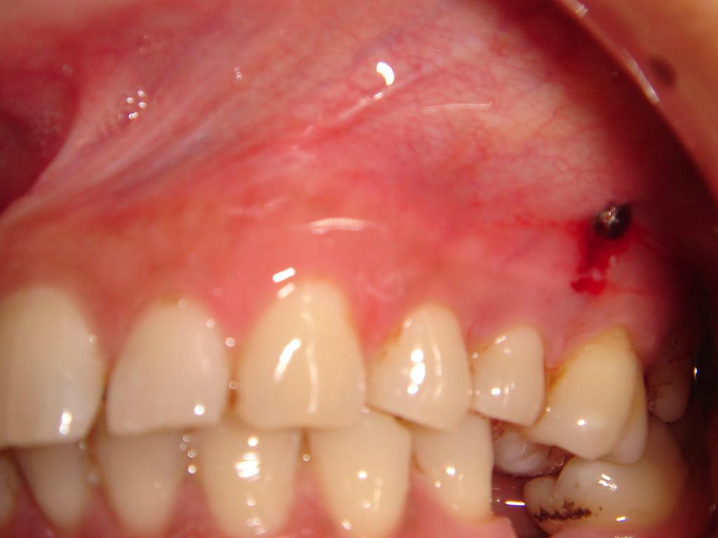 On examination it was observed that the supraerupted teeth had reduced the space available for prosthodontic replacement of missing teeth in vertical dimension.