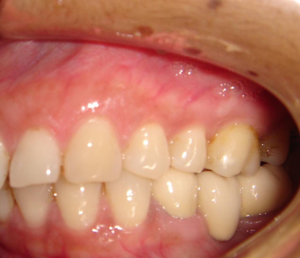 11) The intrusion achieved is stable as the intruded teeth are in occlusion with lower crowns which will prevent their supraeruption.