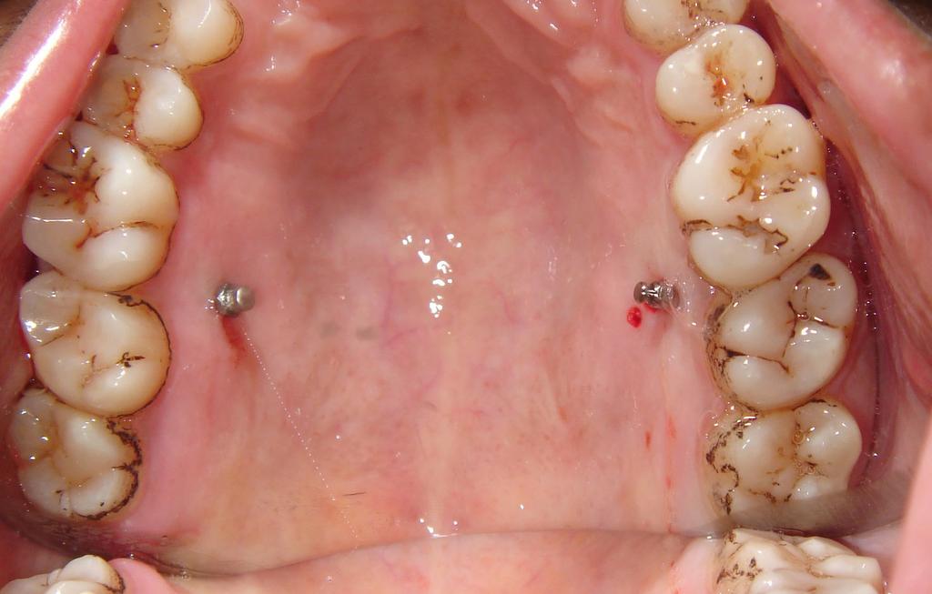 Discussion Microimplants are being used by orthodontists in cases of malocclusion which require high anchorage.