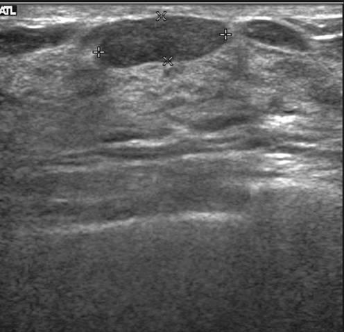 Fig. 1. True negative US. Sonogram shows a 1.4 cm sized, oval, circumscribed and hypoechoic mass in 51-year-old woman with a palpable mass. The assessment prior to biopsy was BI- RADS category 3.