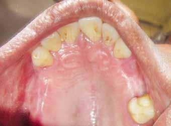 Prosthodontic Rehabilitation of a Partially Edentulous Hemiglossectomy Patient: A Clinical Report making placement of any prosthesis over it difficult, as the movement of the tongue or