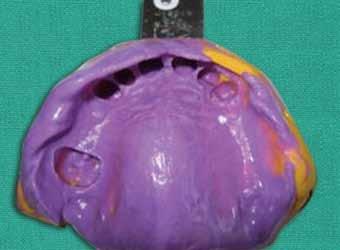 This modified tray was then loaded with irreversible hydrocolloid and impression was made (Fig. 6). The casts were poured in type III dental stone (Kaldent, Kalabhai).
