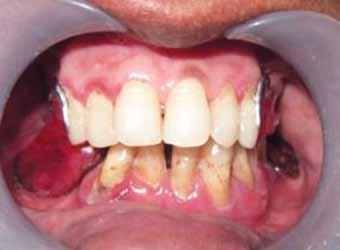 The definitive surveying was carried out for designing of the cast partial denture.