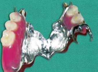 Prosthodontic Rehabilitation of a Partially Edentulous Hemiglossectomy Patient: A Clinical Report cure acrylic resin in conventional manner (Fig. 11).