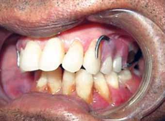 8 This condition is aggravated sometimes by deficient alveolar ridge, suturing of the flap across the crest of the ridge, high tissue attachments, altered floor of the mouth and