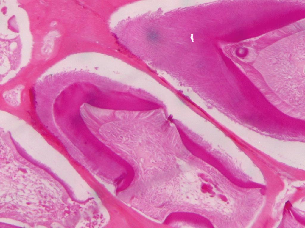 Microscopically, the lesion was composed of two patterns. One with areas of cell-rich mesenchymal stroma, cords, and follicles of odontogenic epithelium, consistent with ameloblastic fibroma.