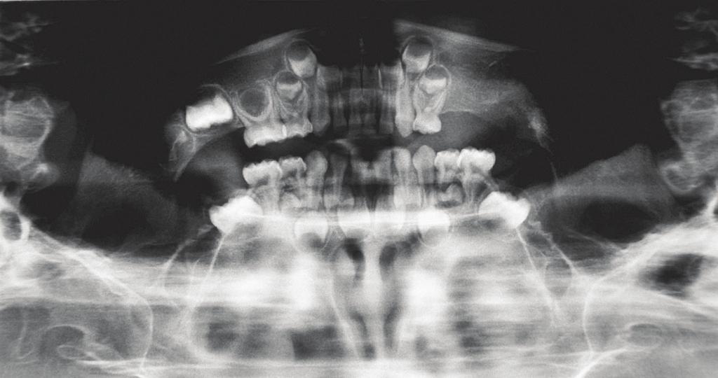 Case Reports in Dentistry 3 Figure 4: Postoperative panoramic radiograph, demonstrating that the radiodensity of the lesion area is similar to normal bone, indicating complete bone regeneration.