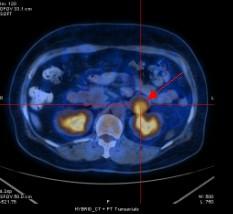 1. 引言患者, 女性,55 岁, 于 2010 年 9 月因在当地医院体检时彩超发现右卵巢占位, 考虑恶性肿瘤, 遂在该院行 右侧卵巢切除术 术中见右卵巢增大约 10 9 8 cm, 质硬, 与子宫后壁形成粘连, 左卵巢萎缩, 子宫正常大小, 浆膜光滑, 未见腹水 术后病理 ( 图 1) 报告 :( 右卵巢 ) 镜下可见异型细胞, 肿瘤细胞呈梭形,