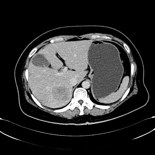 right abdominal soft tissue lesion after the first-line systemic palliative chemotherapy by CT, and the maximum 8 cm; Shows the