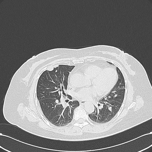 Shows the left adrenal space-occupying lesion after 2 cycles of second-line systemic palliative chemotherapy by CT, and the
