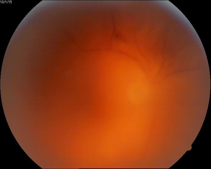 Slit lamp examination of the right eye revealed perikeratic injection, posterior synechiae at 180 degrees inferiorly which deformed