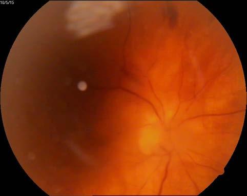The eye fundus showed vitreal floaters and vitritis (Fig.