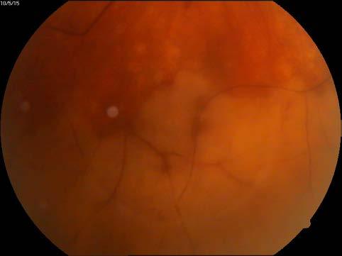 reflex, very narrow blood vessels, phantom vessels especially in peripheral retina, perivascular cuffing (vasculitic aspect) (Fig.