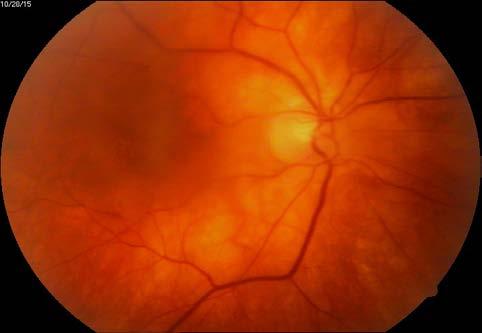 The management of necrotizing retinitis refers, first, to treating the cause of the retinitis.