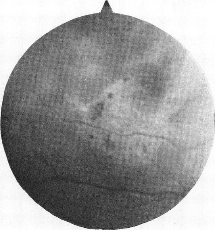 Fundus changes after traumatic hyphaema FIG.