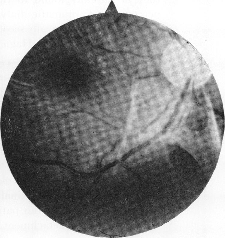 A month later he was found to have a large area of retinal schisis with massive pigmentary disturbance above. He was followed-up for 6 months when the schisis was found to have extended.