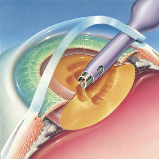 A narrow instrument is inserted through this tiny incision into your eye to gently break up the