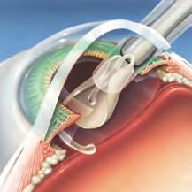 While the lens is removed, the elastic capsule that surrounds it is left intact to allow for the