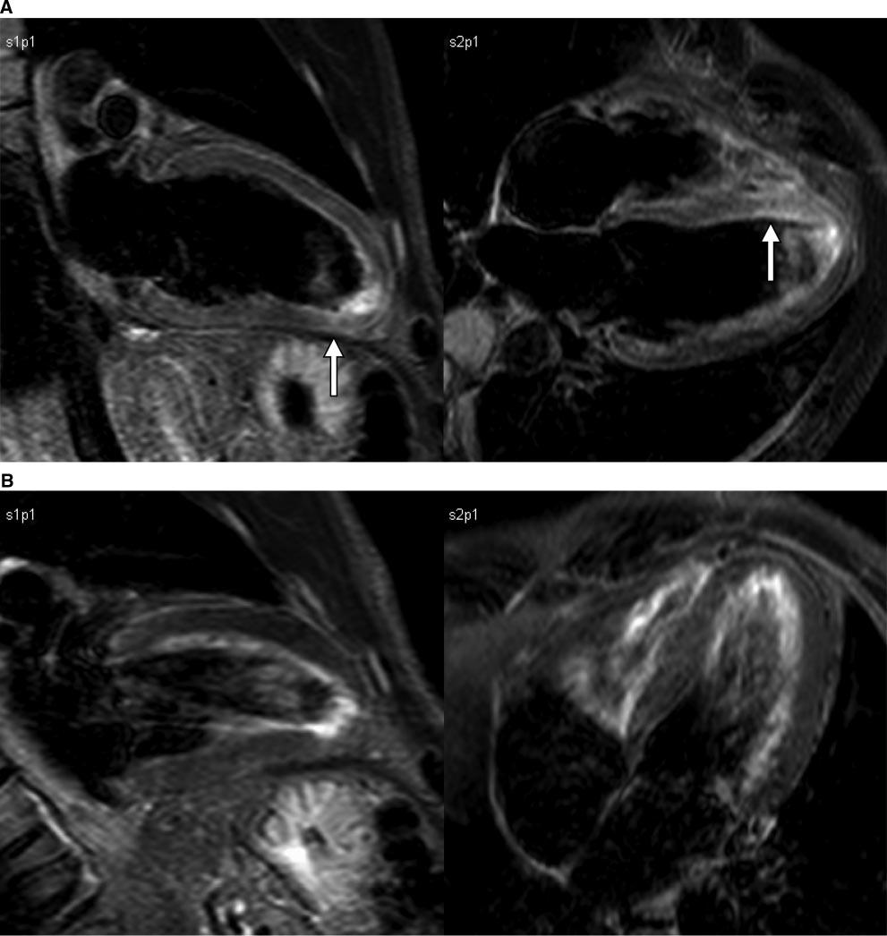Vago et al Cardiac Contusion Diagnosed by MRI 2459 Figure 3.