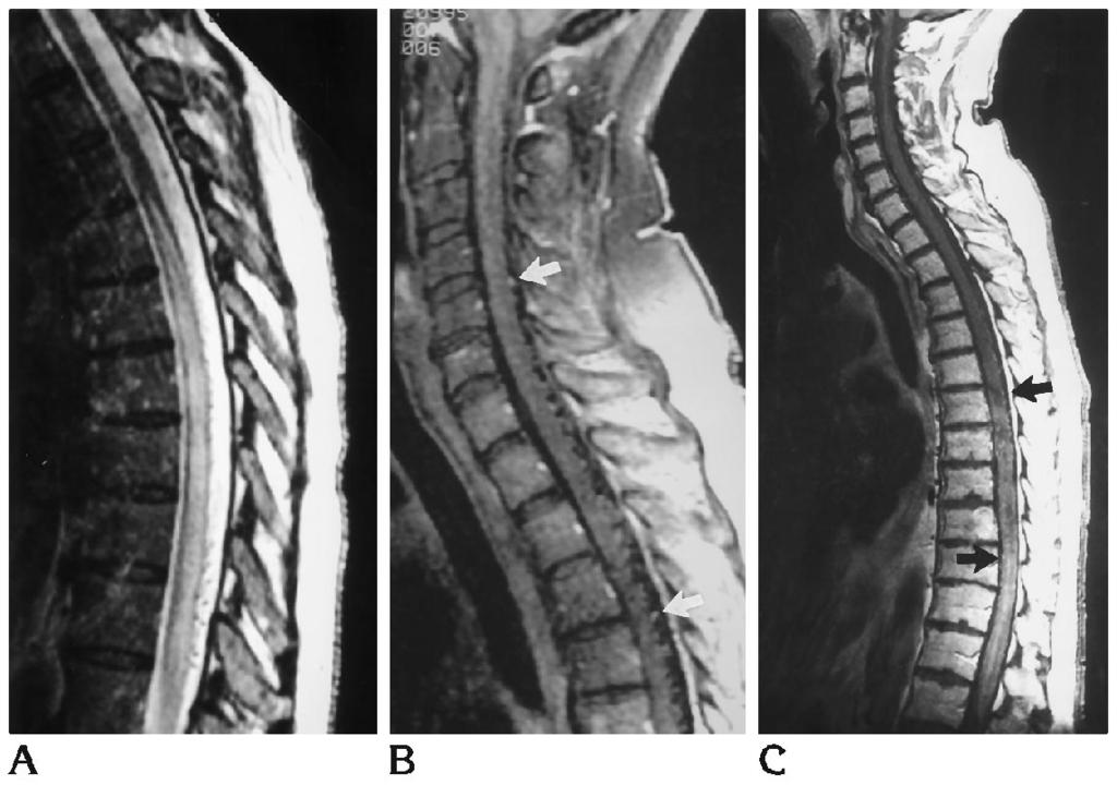 AJNR: 16, November 1995 SPINAL DURAL AVFS 2053 Fig 5. A, Abnormal T2 signal extends over six levels in this patient with a spinal dural AVF at L-3.