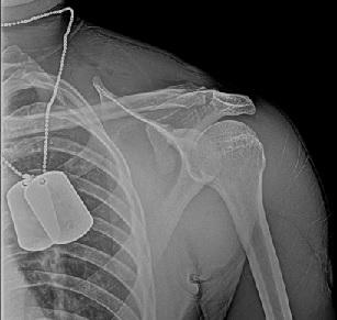 SSSC Sling or shoulder immobilizer x 4-6 weeks Similar protocol to AC/Clavicle fx Close