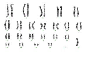 106 Cytogenetic Analysis of Referral Cases with... 6.9 ±4.2 years. Most of them (85%) had normal karyotye (Fig.1). Fifteen percent of them had abnormal karyotype (Fig. 2).