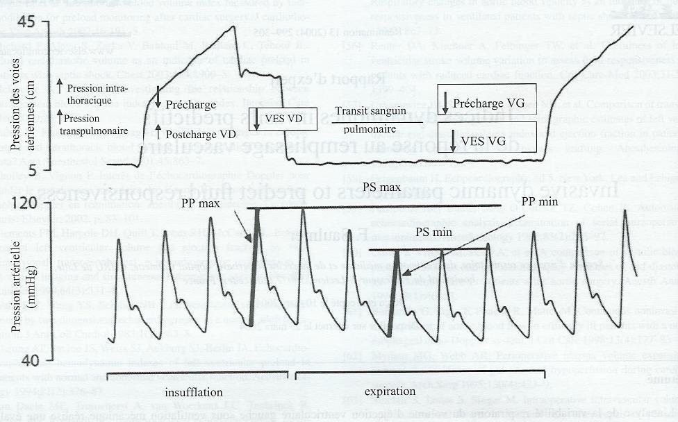 SBP and PP variation during mechanical ventilation PPV = (PPmax