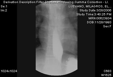 Case Presentation Initial CXR normal Initial esophagram negative for leak. Patient underwent gastroesophagoscopy.