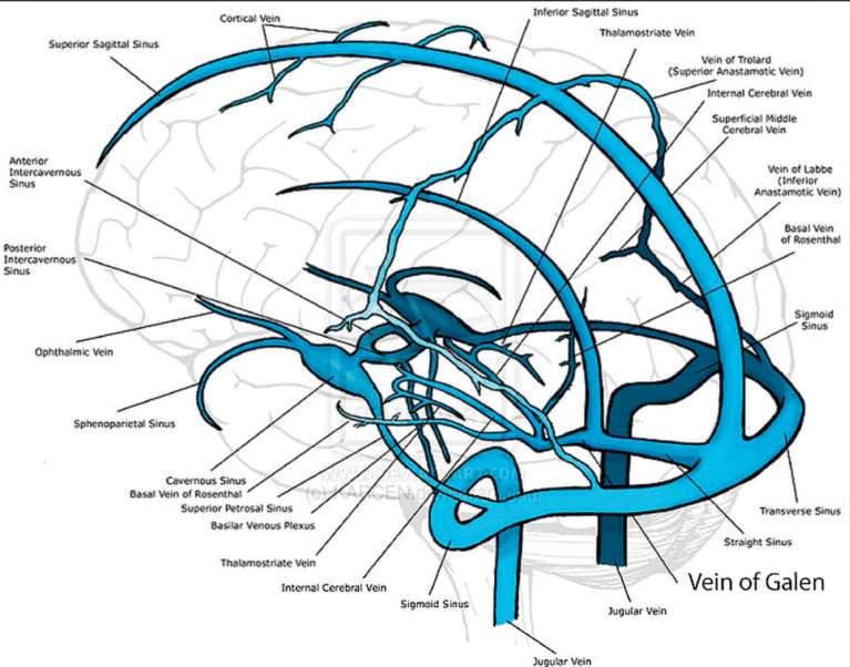 Great cerebral vein The great cerebral vein (of Galen) is a single, midline vein formed inside the brain by the