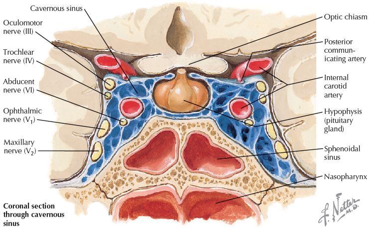 Cavernous sinus syndrome Sepsis from the central portion of the face or paranasal sinuses